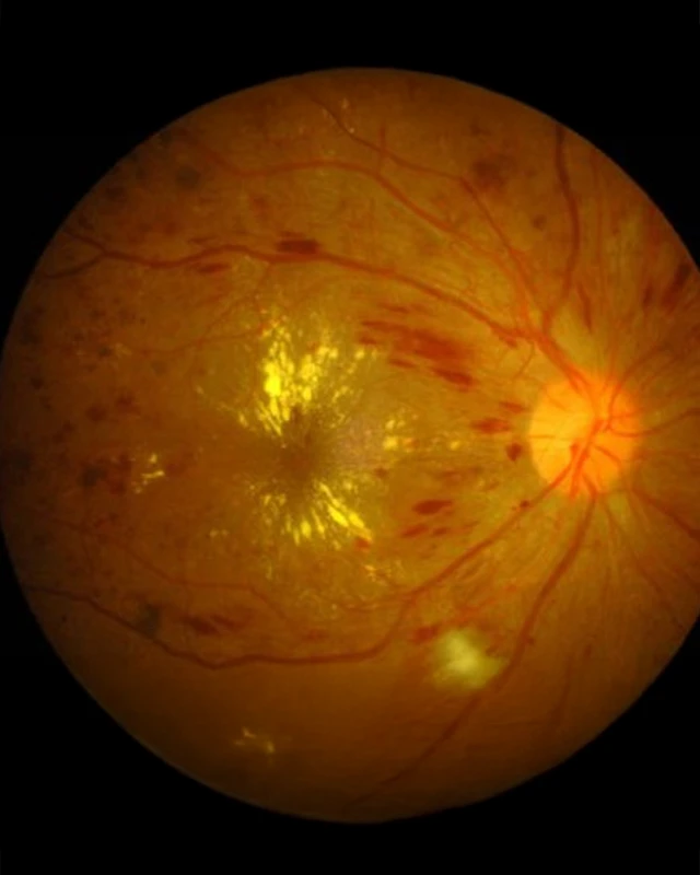 Digital image of a diabetic retina